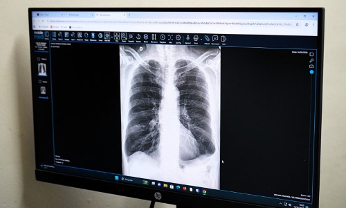 Saúde pública de VR ultrapassa 50 mil exames analisados com auxílio da Inteligência Artificial